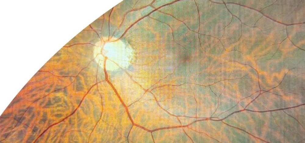 retinal-disorders-introducing-the-common-problems-and-their-symptoms